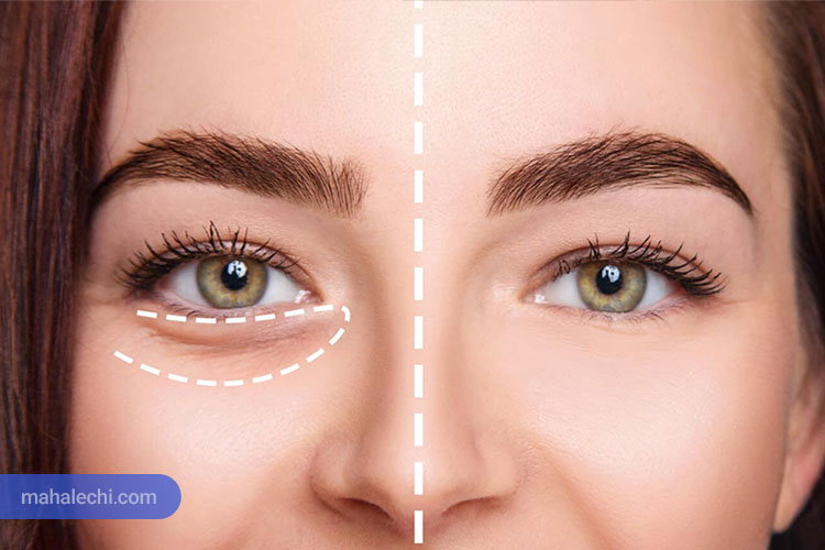 همه چیز درباره فیلر زیر چشم