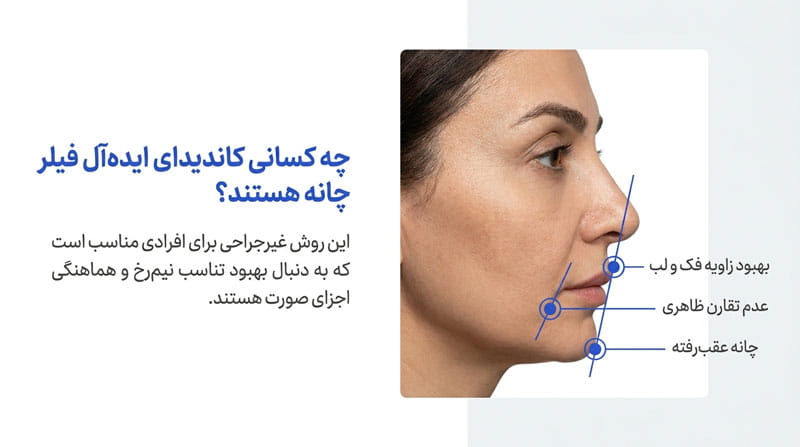 هزینه فیلر گونه در شیراز شامل چه مواردی میشود؟